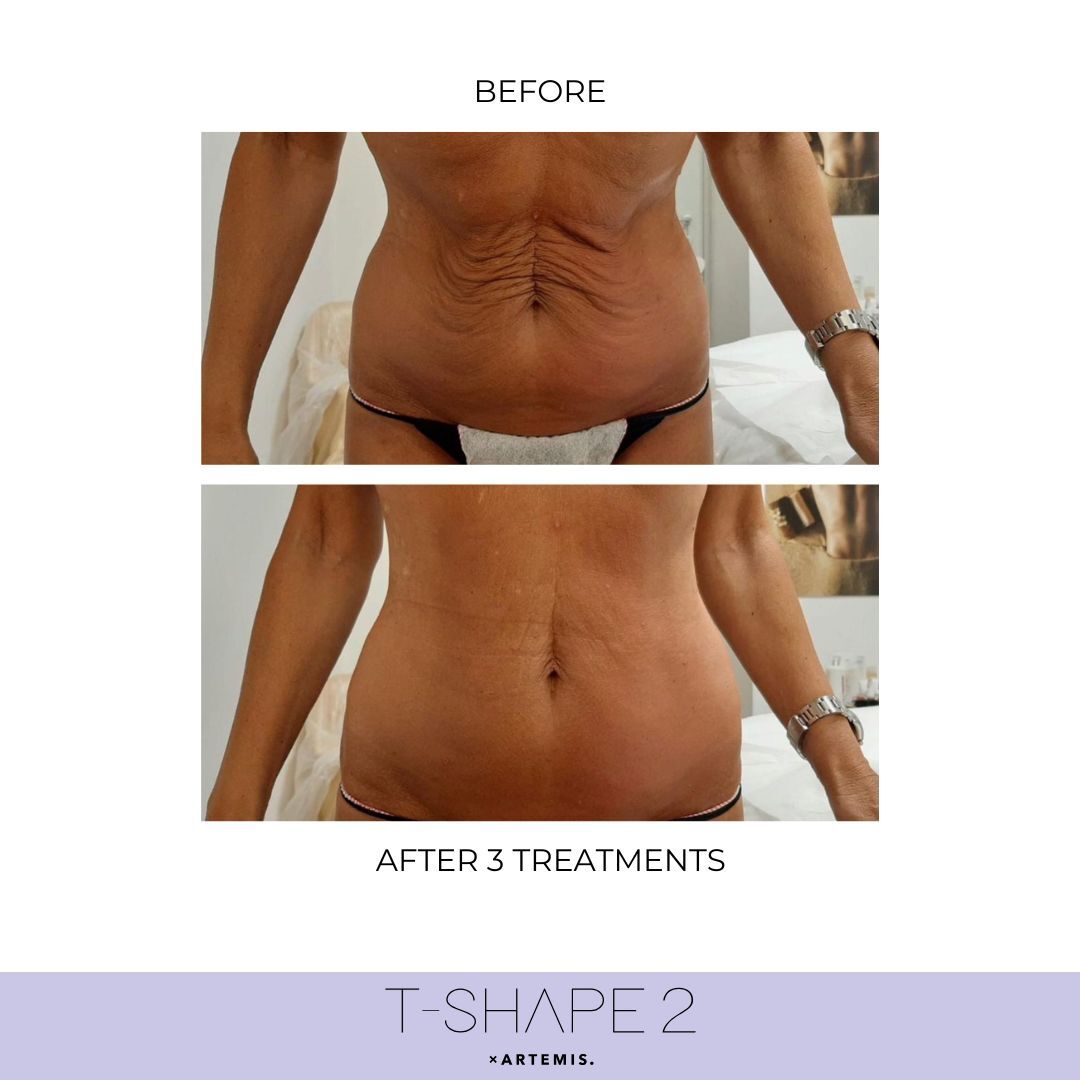Abdomen — After 3 treatments