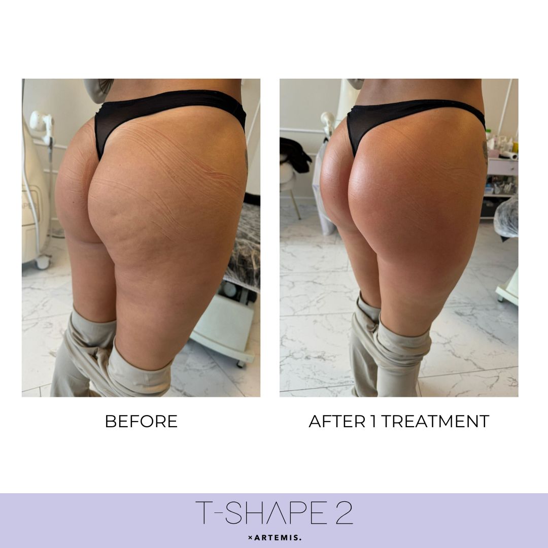 Body — After 1 treatment