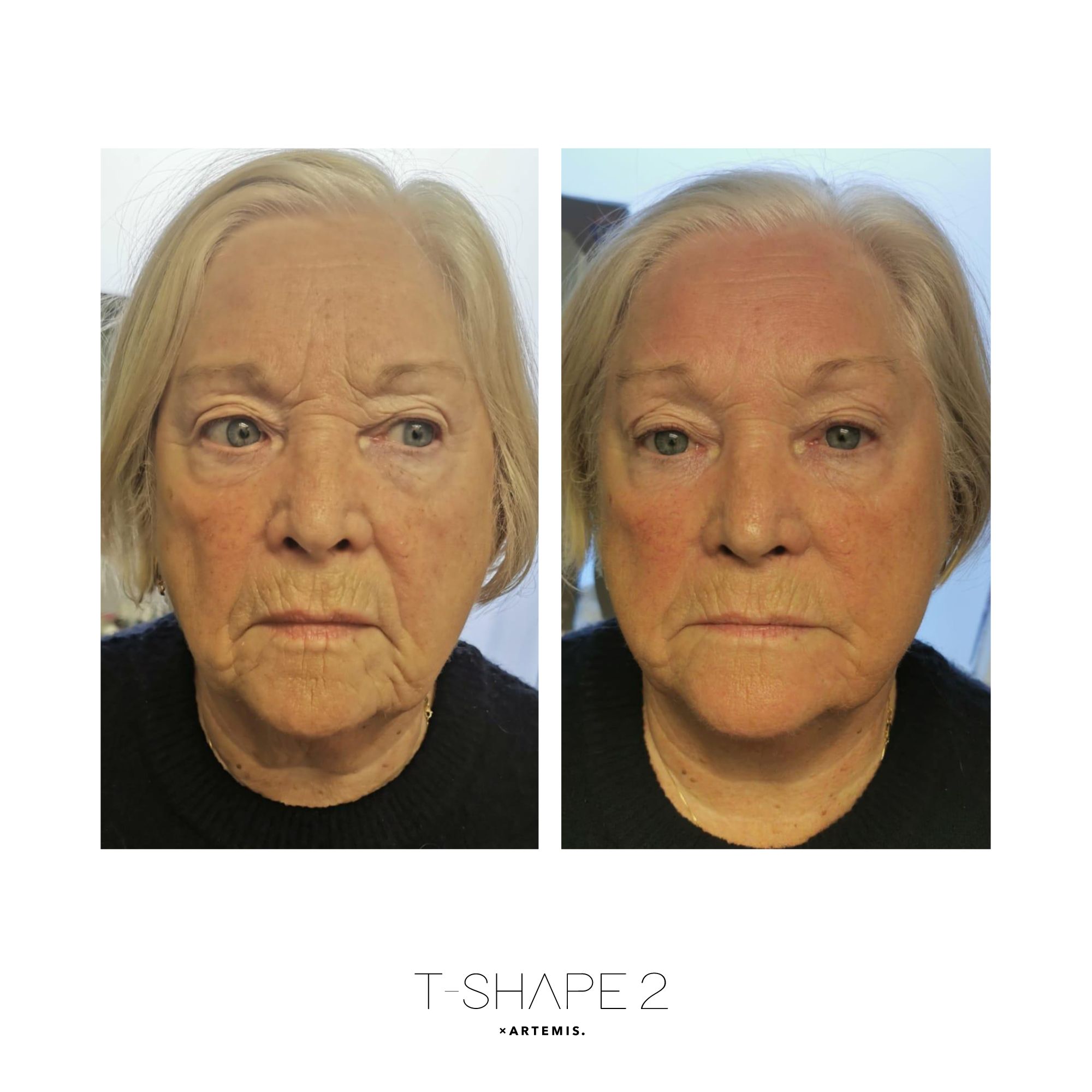 Face — After 1 treatment