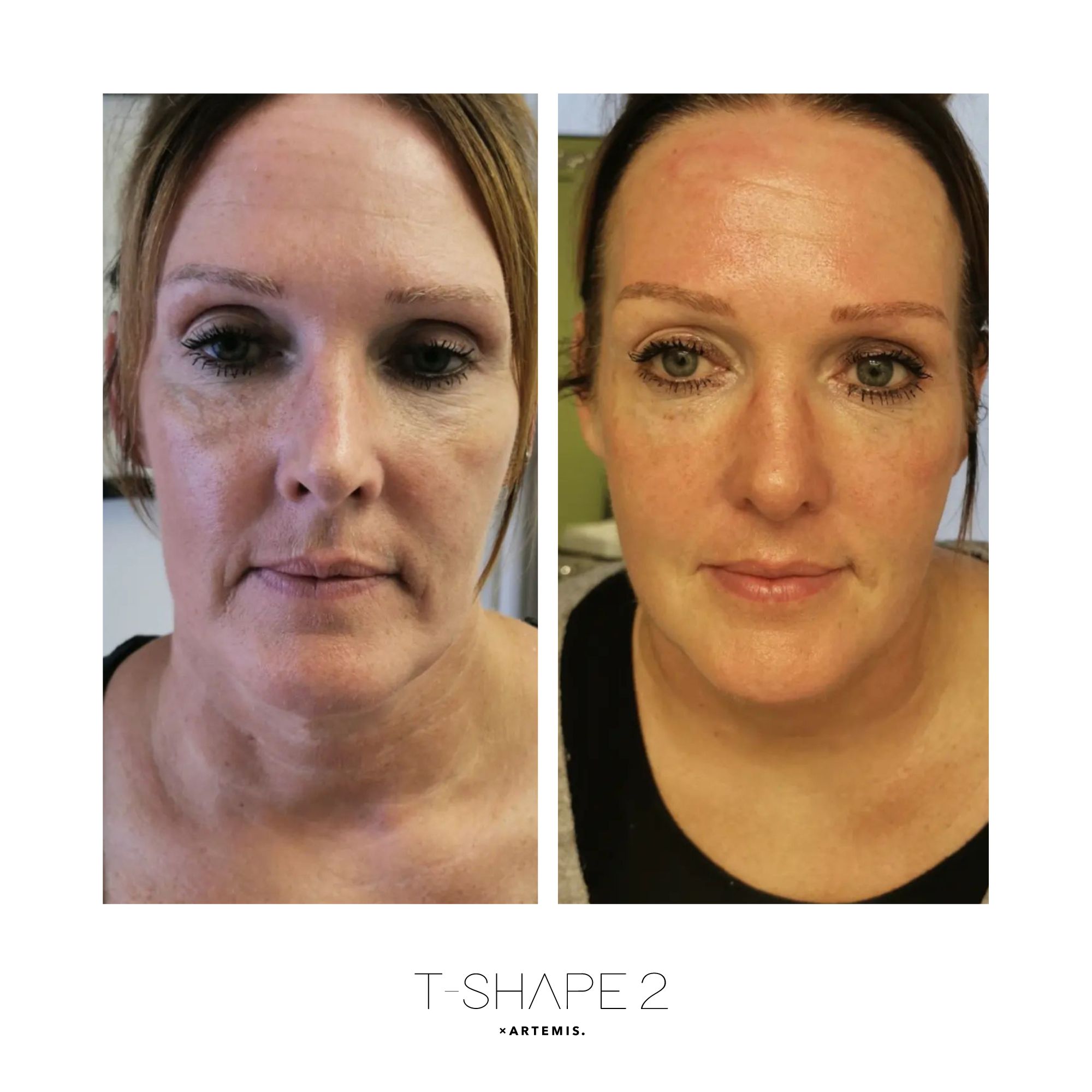 Face — After 4 treatments